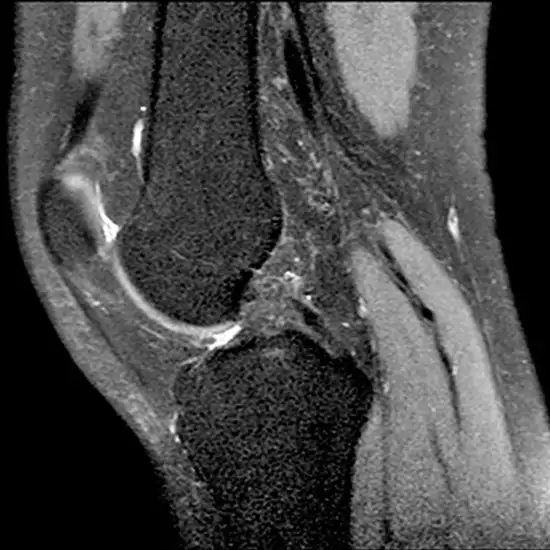 MRI Right Knee With Cartigram